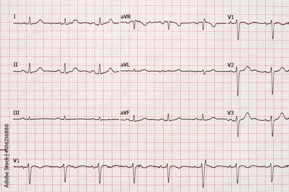 Understanding Atrial Fibrillation: A Beginner’s Guide